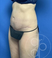 Tummy Tuck After Photo by Danielle DeLuca-Pytell, MD; Troy, MI - Case 47796