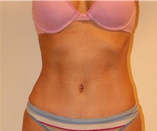 Liposuction After Photo by Jeffrey Yager, MD; New York, NY - Case 42736