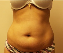 Liposuction Before Photo by Jeffrey Yager, MD; New York, NY - Case 42736