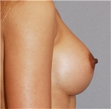 Breast Augmentation After Photo by Ramin Behmand, MD; Nashville, TN - Case 31497