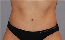 Tummy Tuck After Photo by Ramin Behmand, MD; Nashville, TN - Case 31506