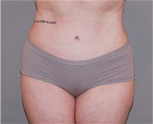 Tummy Tuck After Photo by Ramin Behmand, MD; Nashville, TN - Case 31507