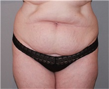Tummy Tuck Before Photo by Ramin Behmand, MD; Nashville, TN - Case 31507