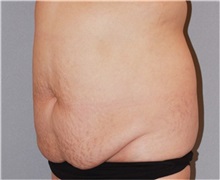 Tummy Tuck Before Photo by Ramin Behmand, MD; Nashville, TN - Case 31510