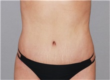 Tummy Tuck After Photo by Ramin Behmand, MD; Nashville, TN - Case 31510