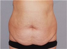 Tummy Tuck Before Photo by Ramin Behmand, MD; Nashville, TN - Case 31510