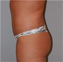 Body Lift After Photo by Ramin Behmand, MD; Nashville, TN - Case 31516