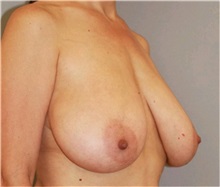Breast Reduction Before Photo by Ramin Behmand, MD; Nashville, TN - Case 31520