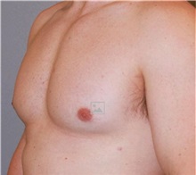 Male Breast Reduction After Photo by Ramin Behmand, MD; Nashville, TN - Case 31521