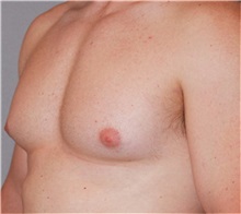 Male Breast Reduction Before Photo by Ramin Behmand, MD; Nashville, TN - Case 31521