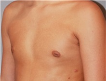 Male Breast Reduction After Photo by Ramin Behmand, MD; Nashville, TN - Case 31522