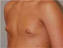 Male Breast Reduction Before Photo by Ramin Behmand, MD; Nashville, TN - Case 31522