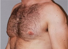 Male Breast Reduction After Photo by Ramin Behmand, MD; Nashville, TN - Case 31523
