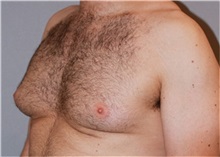 Male Breast Reduction Before Photo by Ramin Behmand, MD; Nashville, TN - Case 31523