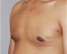 Male Breast Reduction After Photo by Ramin Behmand, MD; Nashville, TN - Case 31524