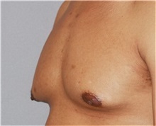 Male Breast Reduction Before Photo by Ramin Behmand, MD; Nashville, TN - Case 31524