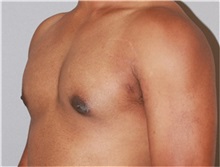 Male Breast Reduction After Photo by Ramin Behmand, MD; Nashville, TN - Case 31525