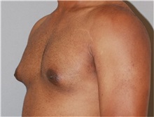 Male Breast Reduction Before Photo by Ramin Behmand, MD; Nashville, TN - Case 31525