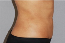 Liposuction After Photo by Ramin Behmand, MD; Nashville, TN - Case 31527
