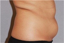 Liposuction Before Photo by Ramin Behmand, MD; Nashville, TN - Case 31527
