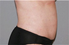 Liposuction After Photo by Ramin Behmand, MD; Nashville, TN - Case 31528
