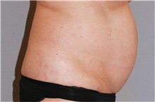 Liposuction Before Photo by Ramin Behmand, MD; Nashville, TN - Case 31528