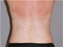 Liposuction After Photo by Ramin Behmand, MD; Nashville, TN - Case 31528