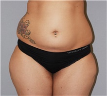 Liposuction Before Photo by Ramin Behmand, MD; Nashville, TN - Case 31529