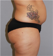 Liposuction Before Photo by Ramin Behmand, MD; Nashville, TN - Case 31529