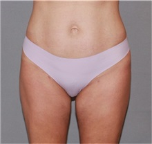 Liposuction After Photo by Ramin Behmand, MD; Nashville, TN - Case 31531