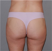 Liposuction After Photo by Ramin Behmand, MD; Nashville, TN - Case 31531
