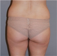 Liposuction Before Photo by Ramin Behmand, MD; Nashville, TN - Case 31531