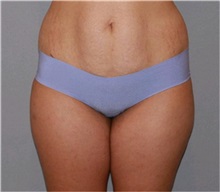 Liposuction Before Photo by Ramin Behmand, MD; Nashville, TN - Case 31532