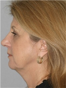 Facelift Before Photo by Ramin Behmand, MD; Nashville, TN - Case 31542