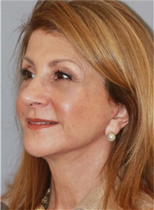 Facelift After Photo by Ramin Behmand, MD; Nashville, TN - Case 31542