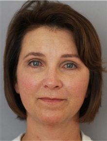 Facelift After Photo by Ramin Behmand, MD; Nashville, TN - Case 31543