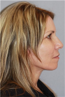Facelift After Photo by Ramin Behmand, MD; Nashville, TN - Case 31544