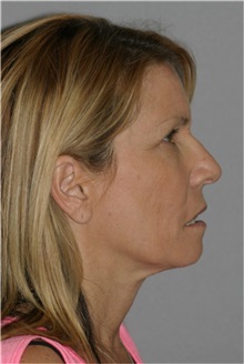 Facelift Before Photo by Ramin Behmand, MD; Nashville, TN - Case 31544
