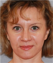 Facelift After Photo by Ramin Behmand, MD; Nashville, TN - Case 31545