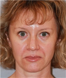 Facelift Before Photo by Ramin Behmand, MD; Nashville, TN - Case 31545