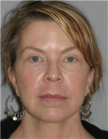 Facelift After Photo by Ramin Behmand, MD; Nashville, TN - Case 31548