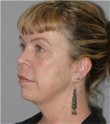 Facelift Before Photo by Ramin Behmand, MD; Nashville, TN - Case 31548