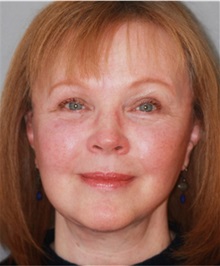 Facelift After Photo by Ramin Behmand, MD; Nashville, TN - Case 31549