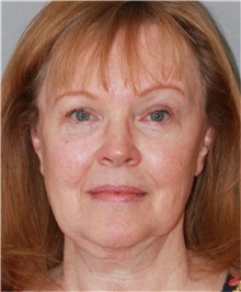 Facelift Before Photo by Ramin Behmand, MD; Nashville, TN - Case 31549