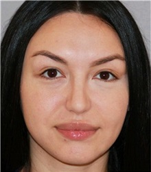 Rhinoplasty After Photo by Ramin Behmand, MD; Nashville, TN - Case 31560