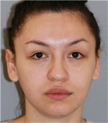 Rhinoplasty Before Photo by Ramin Behmand, MD; Nashville, TN - Case 31560