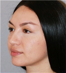 Rhinoplasty After Photo by Ramin Behmand, MD; Nashville, TN - Case 31560