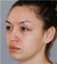Rhinoplasty Before Photo by Ramin Behmand, MD; Nashville, TN - Case 31560