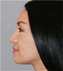 Rhinoplasty After Photo by Ramin Behmand, MD; Nashville, TN - Case 31560