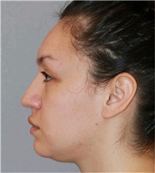 Rhinoplasty Before Photo by Ramin Behmand, MD; Nashville, TN - Case 31560